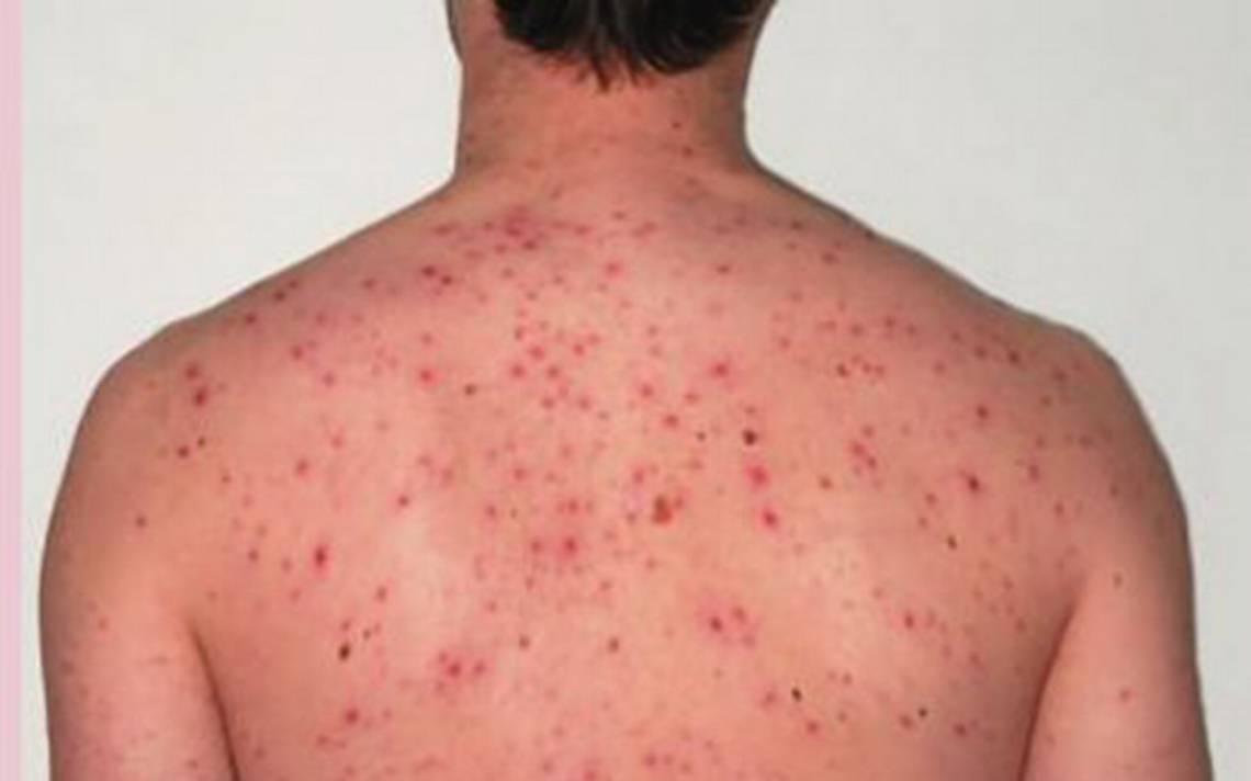 Suman seis muertes por rickettsiosis en el estado