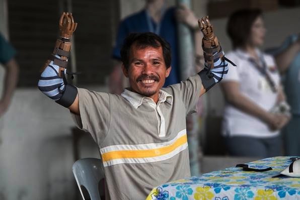 Club Rotario donará prótesis de mano en Torreón