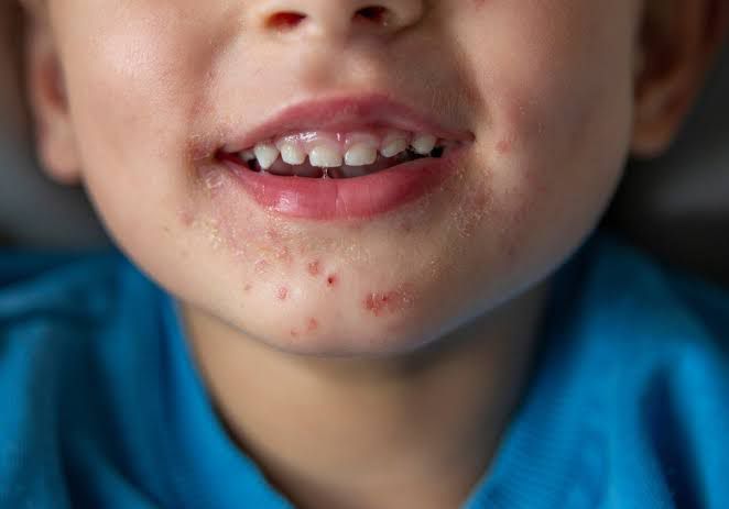 Atienden casos de virus “manos, pies y boca” en escuelas de Saltillo