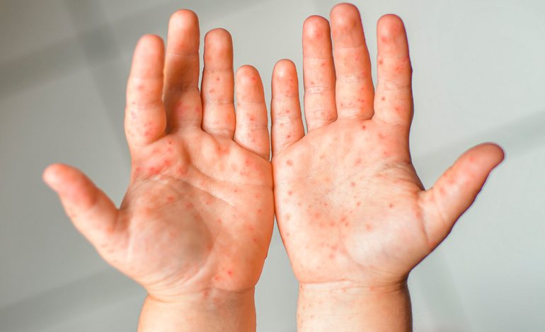 Confirman cuatro casos de sarampión en la Laguna