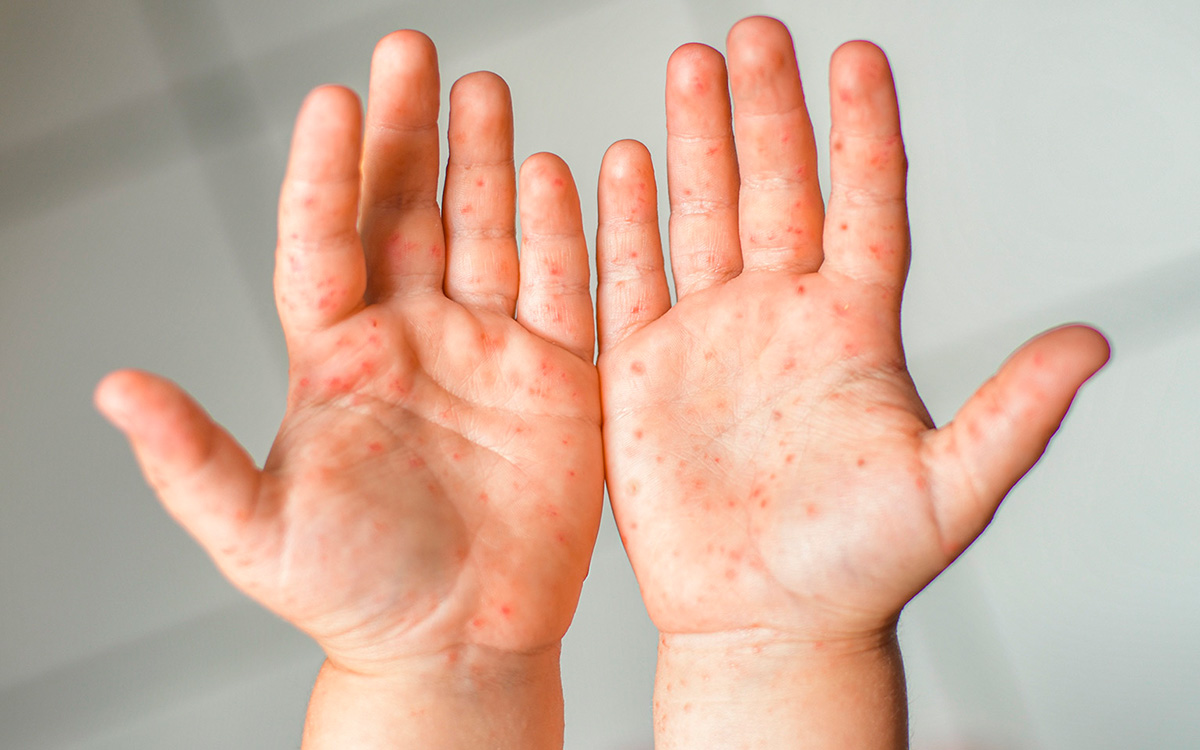 Confirman cuatro casos de sarampión en la Laguna